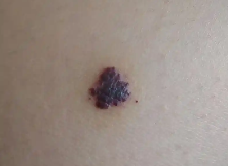 当心！宝宝身上的小红点可能是血管瘤！