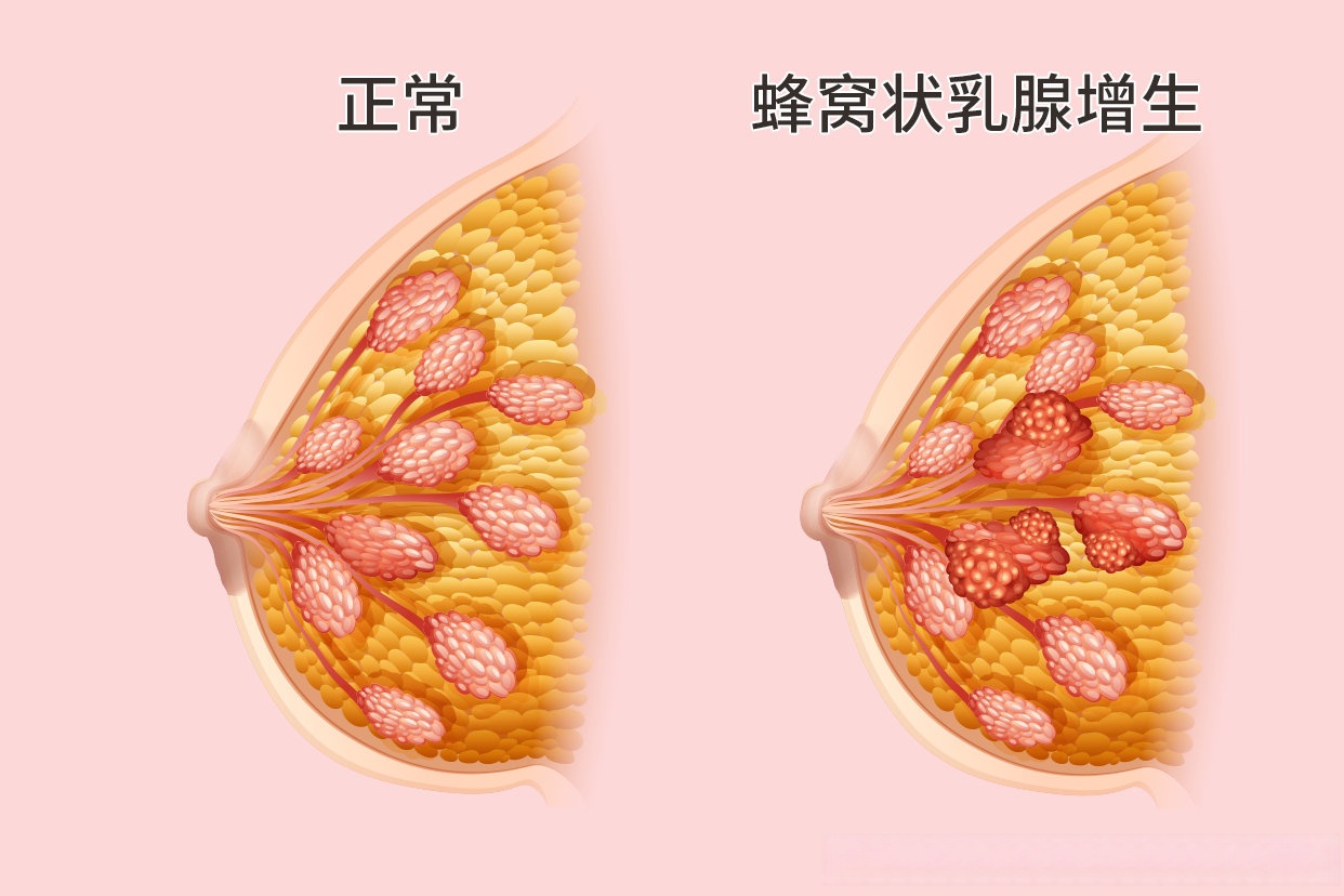 乳腺疾病的谣言，你居然都信了