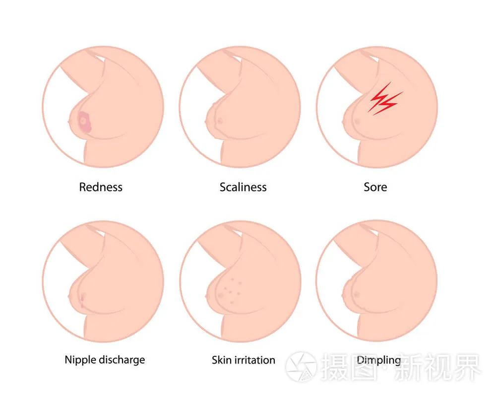 乳腺症状