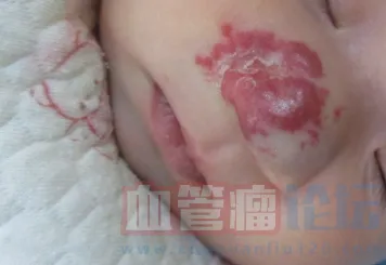 血管瘤的症状及危害