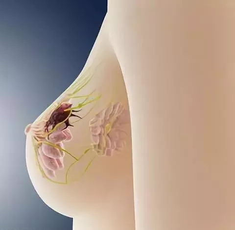 乳腺癌症状