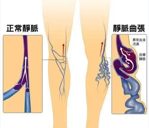 腿上爬满“小蚯蚓” 别等皮肤变黑了再着急，早期静脉曲张，还须做好这3件事
