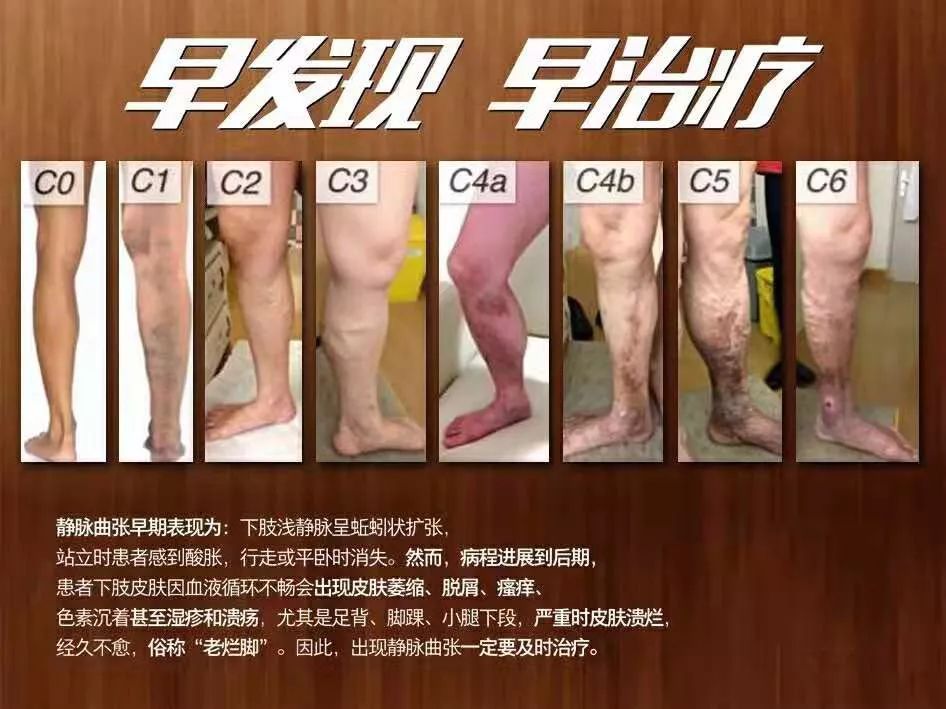 下肢静脉曲张：绝非只是影响美观的“蚯蚓腿”