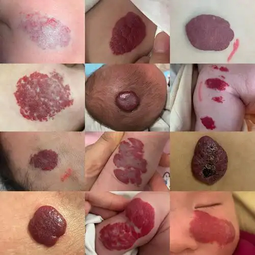 血管瘤不治可以吗