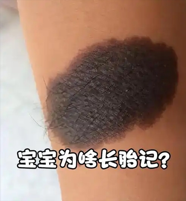 胎记痒是什么原因
