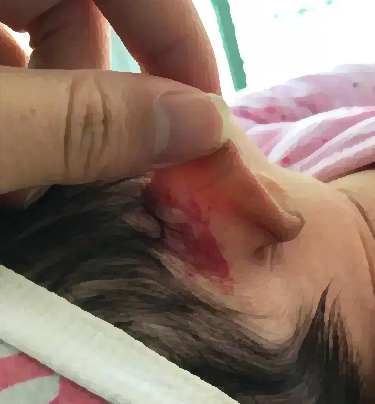血管瘤能根治吗