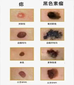色素痣和黑色素瘤的区别