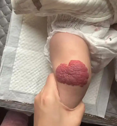 血管瘤最怕2个水果