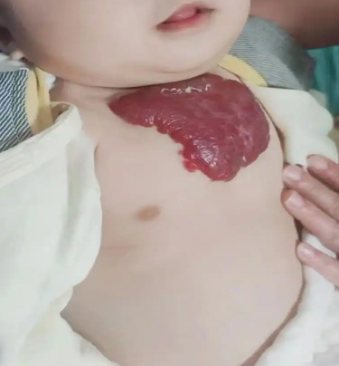 血管瘤需要做手术吗