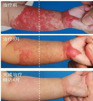 得了血管瘤