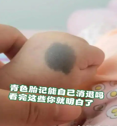 激光去胎记价格表