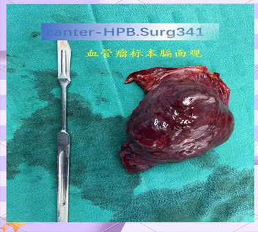 肝血管瘤会恶变吗
