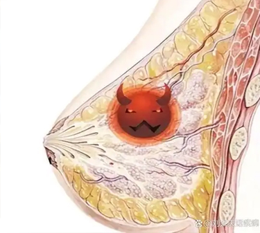 乳腺导管瘤是被气出来的吗