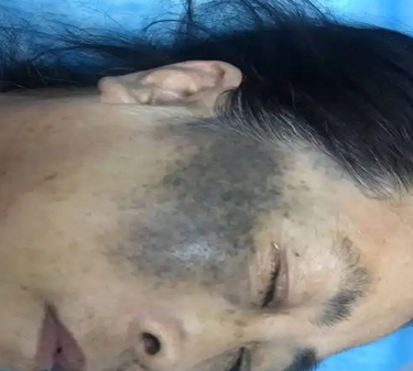 太田痣是天生的吗