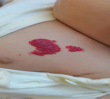 血管瘤危险吗