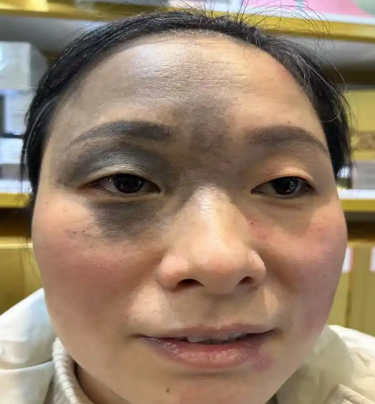 人身上的胎记是怎么来的