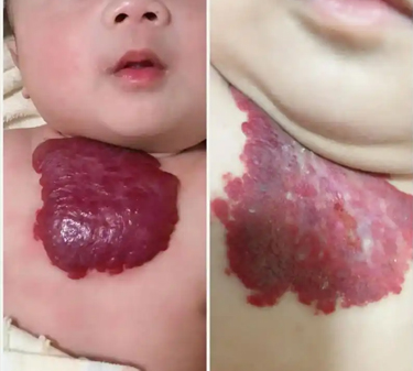皮肤上凸起红色血管瘤