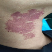 得了鲜红斑痣（红胎记），如何治疗呢？