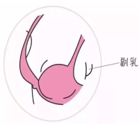 副乳需要切除吗？