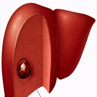 体检发现肝血管瘤要紧吗？医生：不必太过担心 明确诊断非常重要