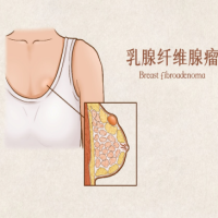 乳腺纤维腺瘤，到底可不可怕？