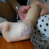 血管畸形是怎么引起的