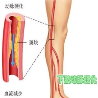 什么是下肢动脉硬化闭塞？