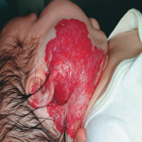 血管瘤结节需要注意什么