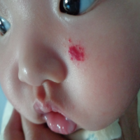 年轻妈妈对孩子身上不消退的小疙瘩不以为然，警惕！可能是血管瘤