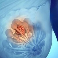 乳腺纤维瘤，你不知道的事？