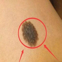色素痣你了解吗？