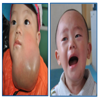 血管瘤困扰之找谁治？怕治坏了？