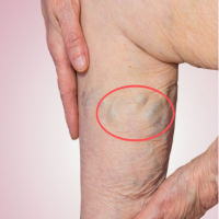 你了解下肢静脉曲张吗？