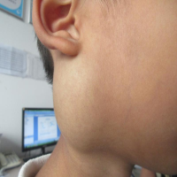 关于胎记与血管瘤：你需要了解的知识都在这