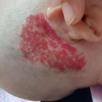 血管瘤不长大用不用治疗