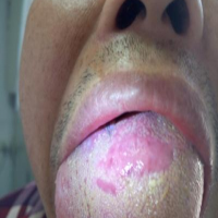 什么是混合型畸形