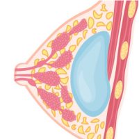 巨乳症科普知识，您了解多少？