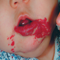 血管瘤是什么引起的