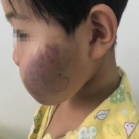 什么是深浅混合型血管瘤