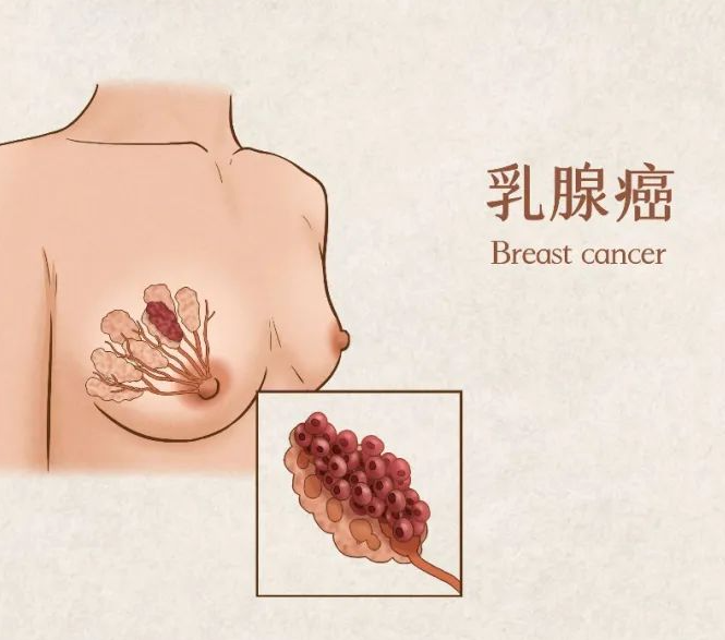 乳腺疾病做什么检查最准确