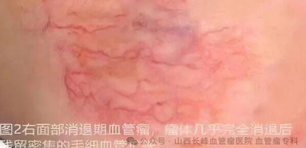 专家科普：血管瘤能否自然消退呢！