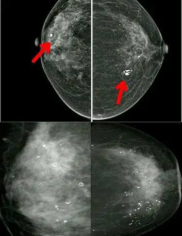 乳腺疾病会引起后背疼吗