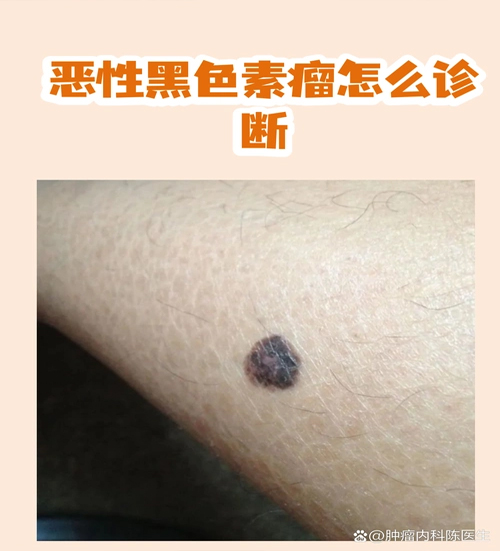色素痣有必要切除吗