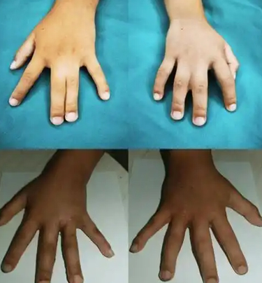 精子混合畸