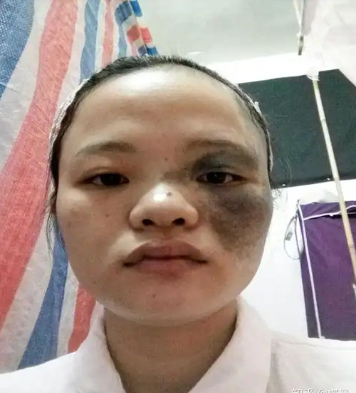 太田痣怎么引起的