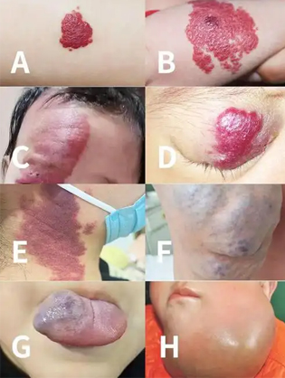 脉管畸形不治疗可以吗