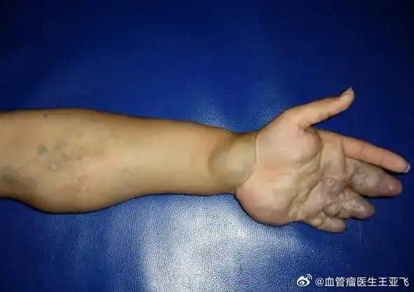 血管畸形是什么原因造成的