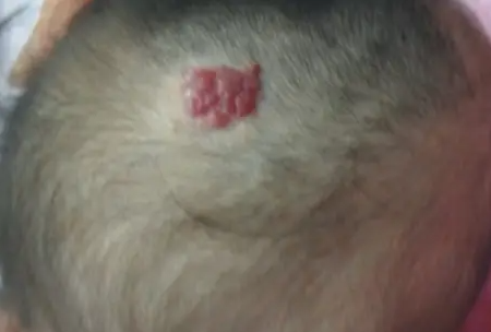 头部血管瘤12_566