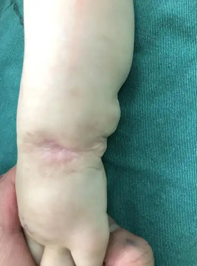 淋巴管畸形