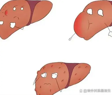 肝上长瘤能活多久